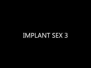 Breast implant removal - Implant sex 3