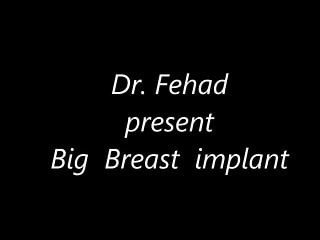 Uneven breast implants Dr.fehad presents big breast implant
